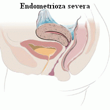2009-08-07_03 36_endometrioza